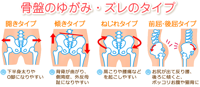骨盤の歪みやズレのタイプ
