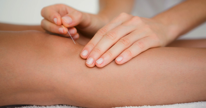 膝に鍼をする写真
